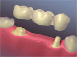 Check spelling or type a new query. Dental Bridges And Oral Health Mile High Dental Implant Centers