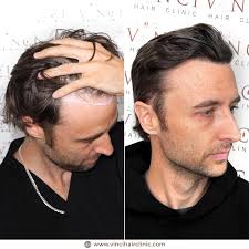 Ever wondered if you could regain your confidence with a restored hairline?  Just ask Johnny Mitchell! As the host of a popular true-crime podcast,  Johnny's on-screen presence matters. So when he decided