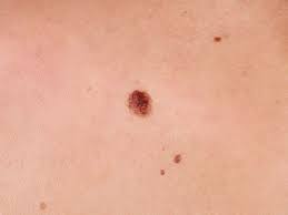 There also are bumps that appear naturally these are known as buttock pimples. Boil Vs Pimple How To Tell The Difference