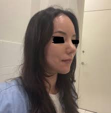 Rhinoplasty at Eight Plastic Surgery