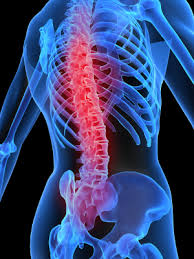 Back pain, is pain felt in the back. Back Pain Ventura Musculoligamentous Strain Spondylolysis Oxnard Thousand Oaks