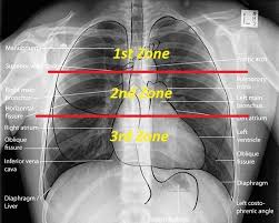 May 10, 2019 vsevolod zviryk. Basics Of Reading Chest X Ray Medical Case Consultation Www Medicaltalk Net The Best Medical F Medical Studies Medical Anatomy Human Anatomy And Physiology