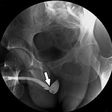 Image result for Retrograde Urethrogram