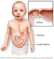 Spinal stenosis is a term used to describe a narrowing of the spinal canal. Pyloric Stenosis Symptoms And Causes Mayo Clinic