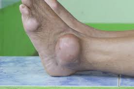 Image result for gout