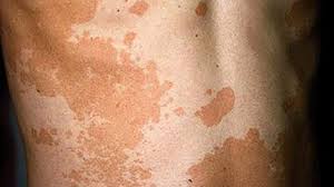 Benefits of calamansi juice include bleaching the skin, detoxifying the body, aiding in. White Spots On Skin What S Causing It