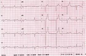Image result for Lyme Carditis