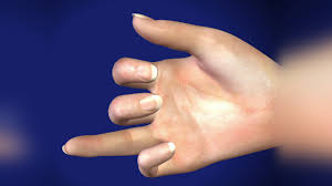 Image result for Hand Extensor Tendon Injury
