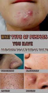 Pin On Natural Acne Remedies