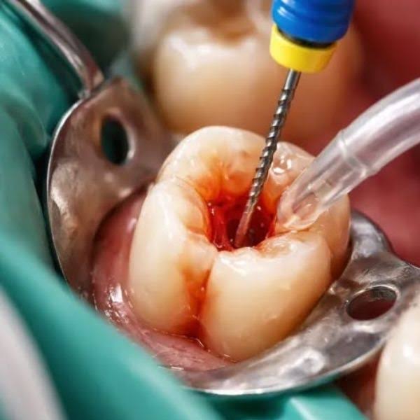 Root Canal Treatment in Pashan product image