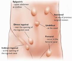 The Health Hub Hernia Hernia Symptoms Hernia Repair Abdominal Hernia