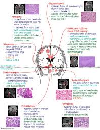 Map Of Brain Tumors Brain Tumor Cancer Nurses Brain Surgeon