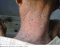 Image result for scabies norvegica
