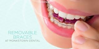 Gum inflammation, headaches, and increased plaque growth are common side effects of both braces treatment and pregnancy. Braces Adult Orthodontics In Northern Ireland At Monkstown Dental