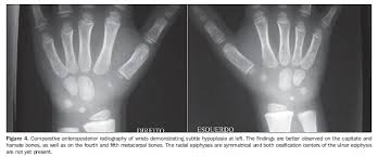 Gary burghoff has a deformed hand, specifically his left one. Poland S Syndrome Radiologic Findings