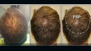 The treatment provides excellent results, and these results can be improved further by combining it with other treatments. Hair Loss Problem Why Not Consider Prp Treatment