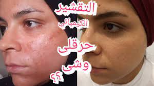 تجربه التقشير الكيميائي لإزاله آثار الحبوب و البقع و غمقان البشره مشاكل التقشير Chemical Peel Youtube