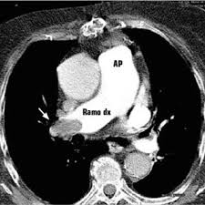 Principles of pulmonary protection in heart surgery con il. Angio Tc Polmonare Spirale La Freccia Indica Difetto Di Riempimento Download Scientific Diagram