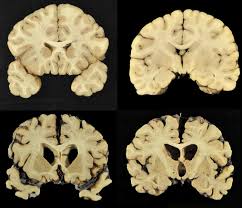 System brainscan oparty o sztuczną inteligencję umożliwia automatyczną detekcję i klasyfikację zmian patologicznych występujących w badaniu obrazowym tk mózgu. Science Says How Repeated Head Blows Affect The Brain