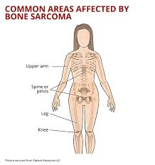 Bone pain can cause a dull or deep ache in a bone or bone region (e.g., back, pelvis, legs, ribs, arms). Bone Sarcoma