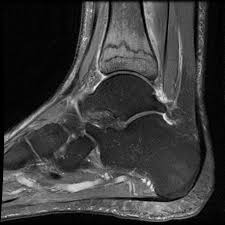 Image result for Tibia Stress Fracture