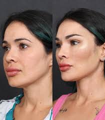 GLIDELIFT is patented procedure invented by Dr Sozer. It is for younger  patients who desire a different, more exotic look. The incision is hidden  in the hair so there are no visible