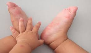 They often peel, leaving an ulcer, which is a sore with a reddish base. Hand Foot Mouth Disease Raffles Medical