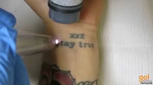 X tattoo removal is listed as having a total annual revenue of $72,000. Straight Edge Laser Tattoo Removal Youtube