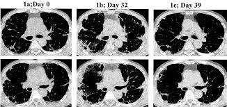 Image result for Pulmonary Intoxicant