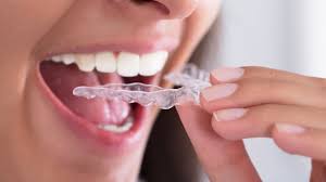 Ensure the water is changed daily as it helps in fighting bacterial growth. How To Clean Night Guard Anderson Lake Dental
