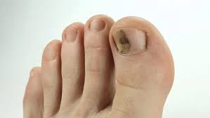 According to the american osteopathic college of dermatology (aocd), the first symptom of a subungual hematoma is a throbbing pain in the nail area, thanks to the pressure of blood pooling under the nail bed. How To Get Rid Of Bruised Toenail Fast With Home Remedies
