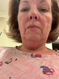 For all my friends following my journey, my 4 week follow up today. Still  some swelling and bruising but all is well. Love the staff and my surgeon.  I feel SO much