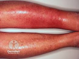 Image result for Skin Infection