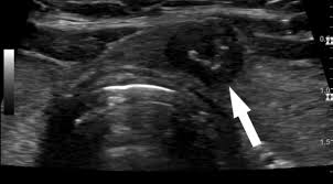 Follicular thyroid cancer and papillary thyroid cancer are the most common differentiated thyroid cancers. Indolent Thyroid Cancer New Challenges From An Epidemic Of Diagnosis On Medicine