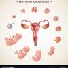 What does ivf stand for in medical? 1