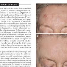 Side effects are more prevalent and severe in individuals with decreased kidney function. Pdf Foreign Body Granulomas Caused By Polymethylmethacrylate Microspheres Successful Treatment With Allopurinol