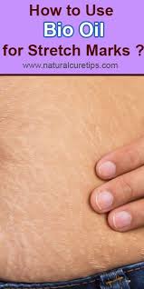 Bio Oil Before And After Pregnancy Stretch Marks How To Use Bio Oil For Stretch Marks Oil For Stretch Marks Bio Oil Stretch Marks Bio Oil Uses