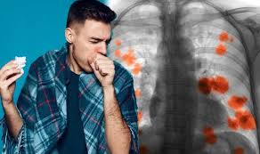 Symptoms and treatments for lung cancer in nonsmokers are typically similar to those in smokers. Lung Cancer Symptoms If A Person Has Bronchitis It Could Be An Early Sign Of The Disease Express Co Uk
