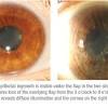 Over 15 years of lasik experience. 1