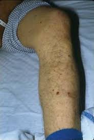 Once purpura fulminans is suspected, workup should begin immediately to identify the underlying etiology. Cancer Patients And Skin Disease Springerlink