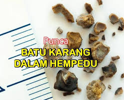 Jangan terkejut jika batu yang keluar berjumlah lebih dari 100 biji bergantung pada keadaan hempedu kita ketika itu. Cara Atasi Masalah Batu Karang Hempedu Ketika Mengandung