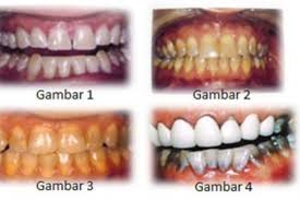 Cara memutihkan gigi secara alami tidak akan memberikan hasil dengan instan, biasanya butuh waktu beberapa minggu sampai terlihat perubahan positifnya. Gigi Kuning Akibat Antibiotik Halaman All Kompas Com