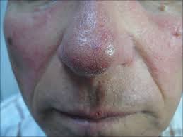 Image result for demodex rosacea