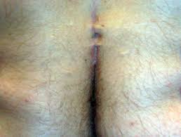 The sinus tract goes in a vertical direction between your buttocks. Pilonidal Disease Dermnet Nz