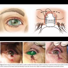 Image result for Eyelid Closure Defect