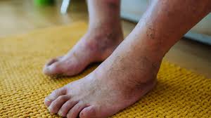 Image result for Lipodermatosclerosis