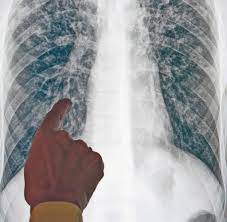 Normalerweise behält die immunabwehr des körpers die. Infektion Die Schleichende Ruckkehr Der Tuberkulose Welt