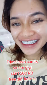 Veneer Gigi Murah dan Tips Perawatan Gigi