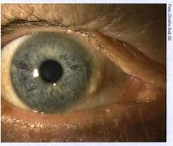 Image result for lesion sclera