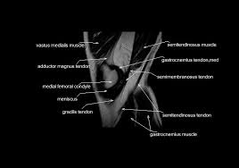 Learn about knee anatomy muscle with free interactive flashcards. Mri Knee Cross Sectional Anatomy Sagittal Image 17 Knee Mri Mri Gastrocnemius Muscle